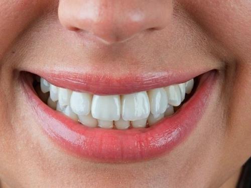 Восстановление передних зубов