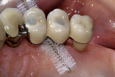 Чистка зубных отложений с имплантата