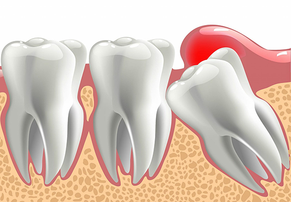 Перикоронит зуба