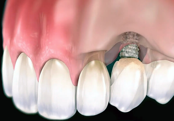 Что такое периимплантит и как его лечить