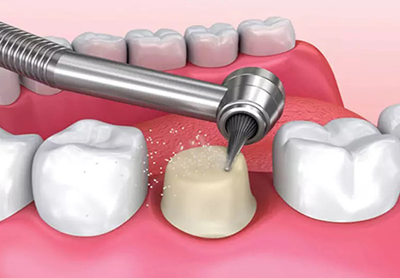 Обточка и препарирование зубов