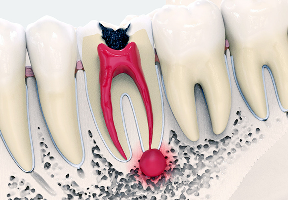 Киста челюсти