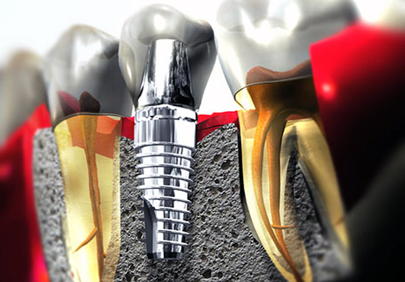 Остеоинтеграция имплантата