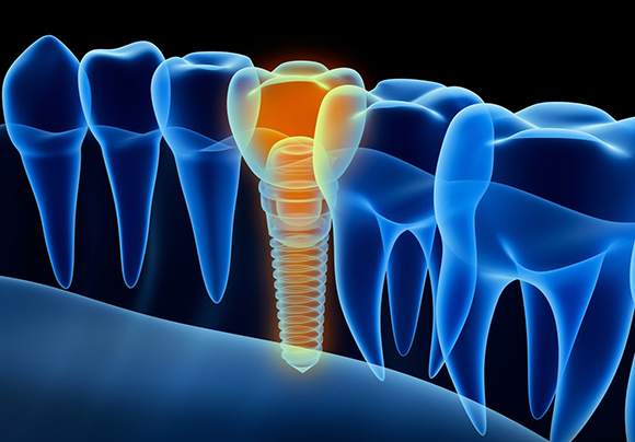 Как ухаживать за имплантами