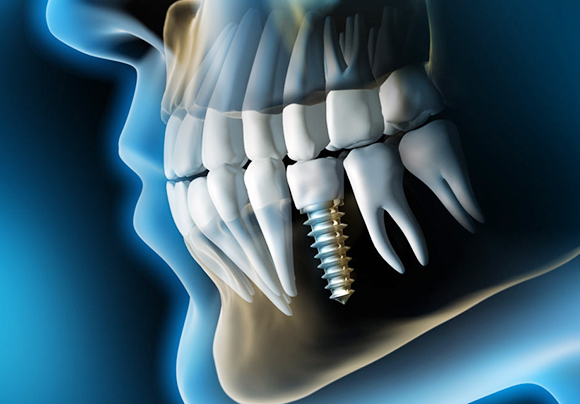 Противопоказания к имплантации