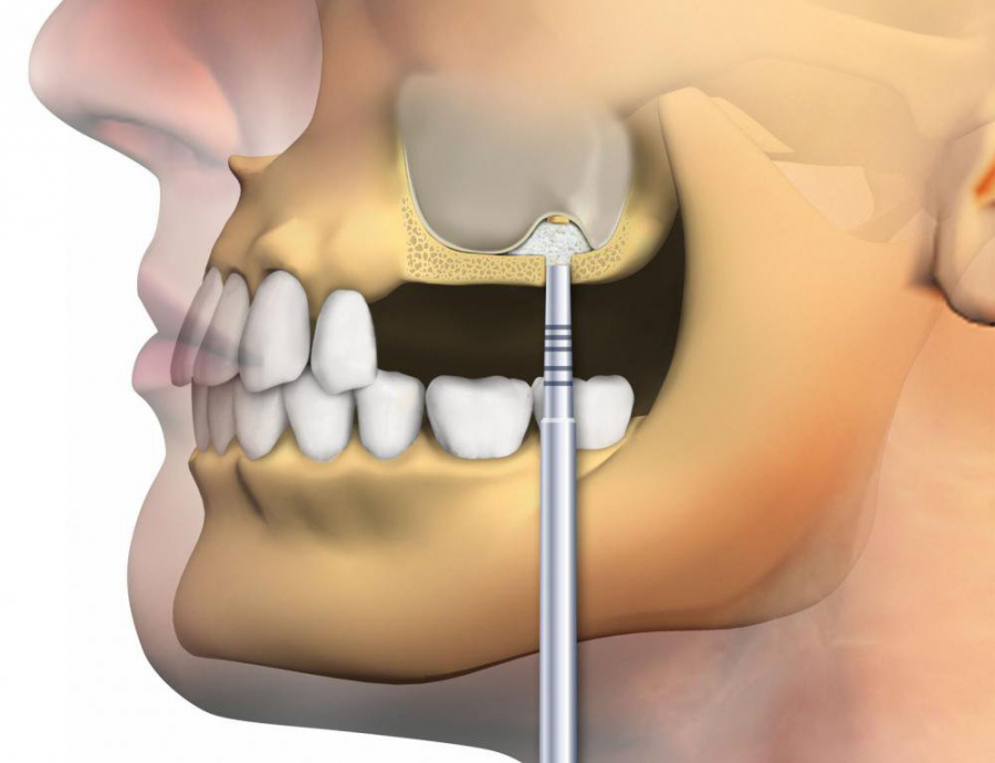 Синус-лифтинг