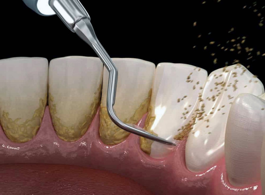 Ультразвуковая чистка зубов