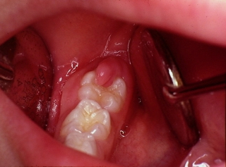 Лечение перикоронарита (удаление капюшона зуба мудрости)