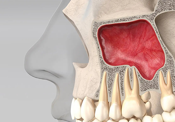 Перфорация верхнечелюстной пазухи