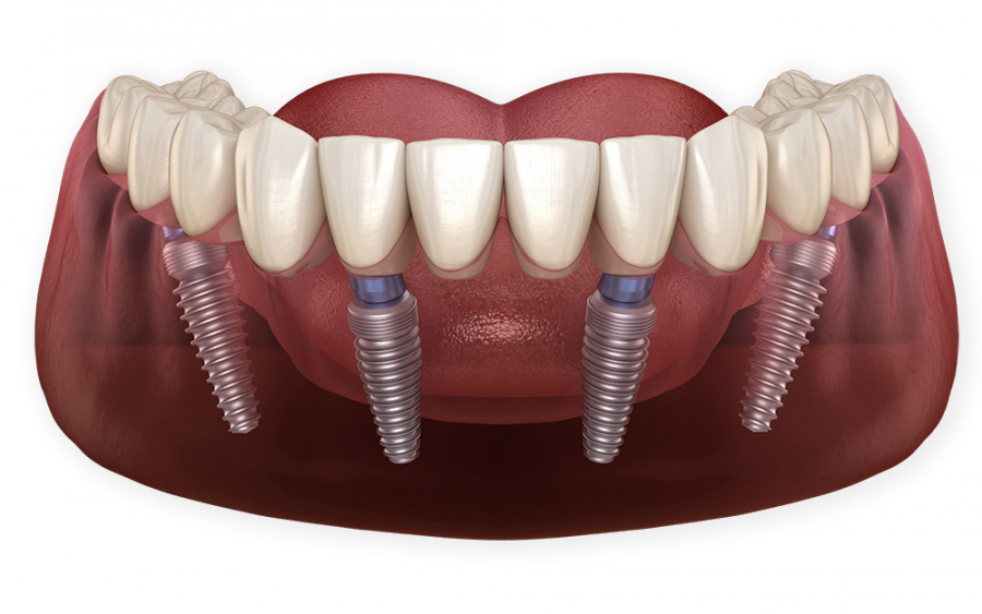 Имплантация All-On-4