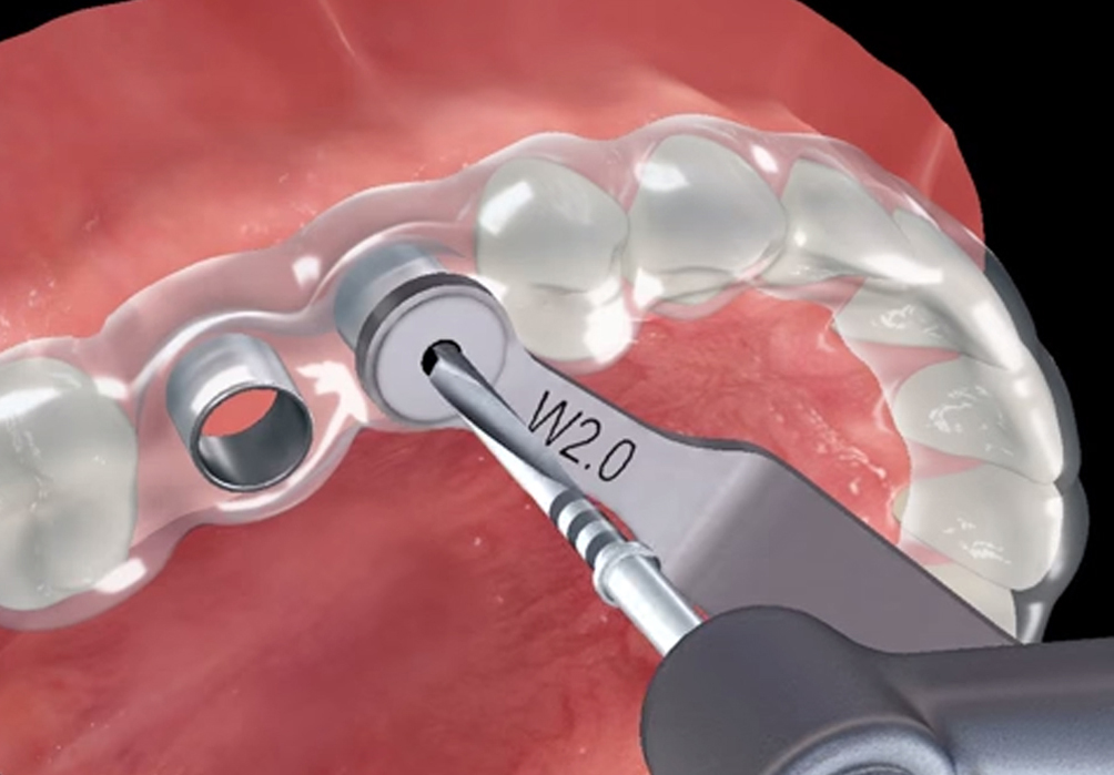 Шаблонная имплантация