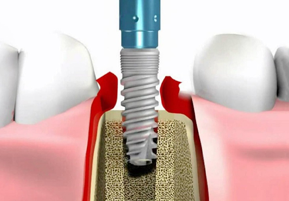 Повторная имплантация