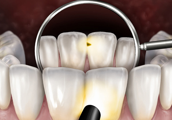 Боковой кариес