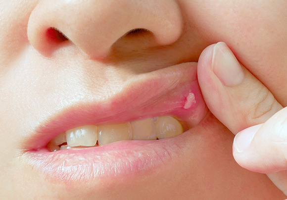 Язва на десне