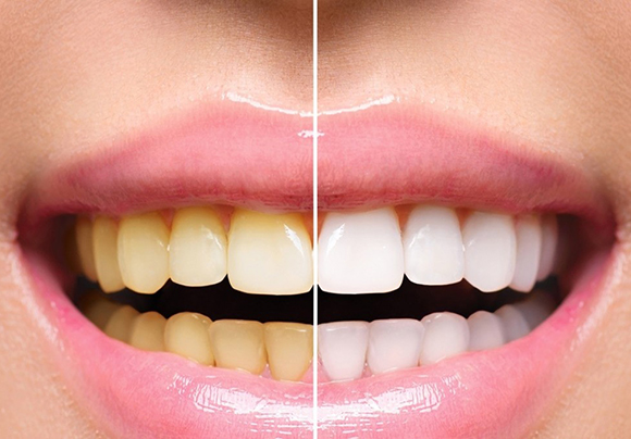 Желтый налет на зубах