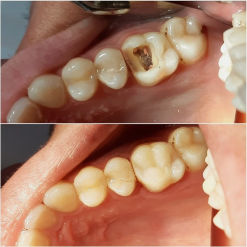 Восстановление жевательных зубов