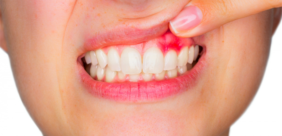Лечение десен