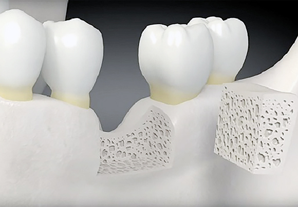 Атрофия костной ткани зубов