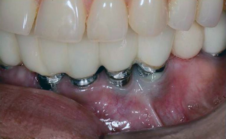 Периимплантит на фото