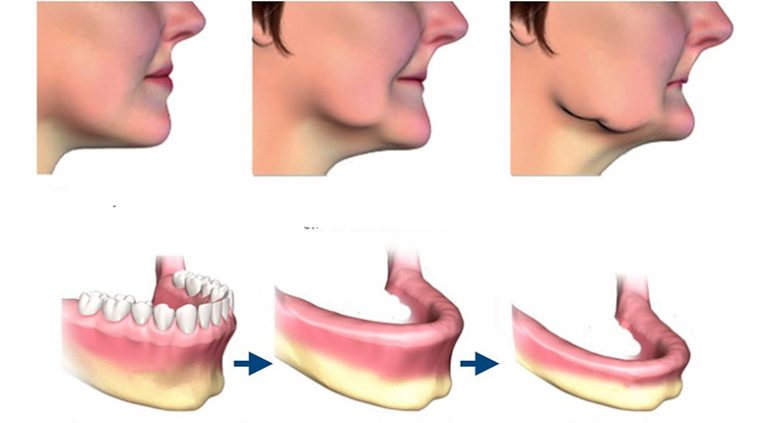 Атрофия костной ткани