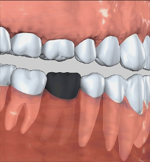 implantaciya-zubov2.jpg