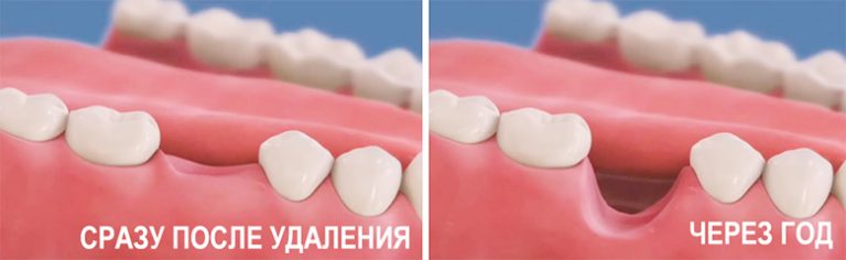 Деградация костной ткани