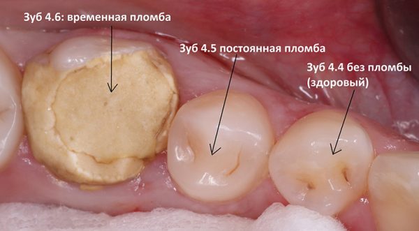 Как выглядит временная пломба во рту