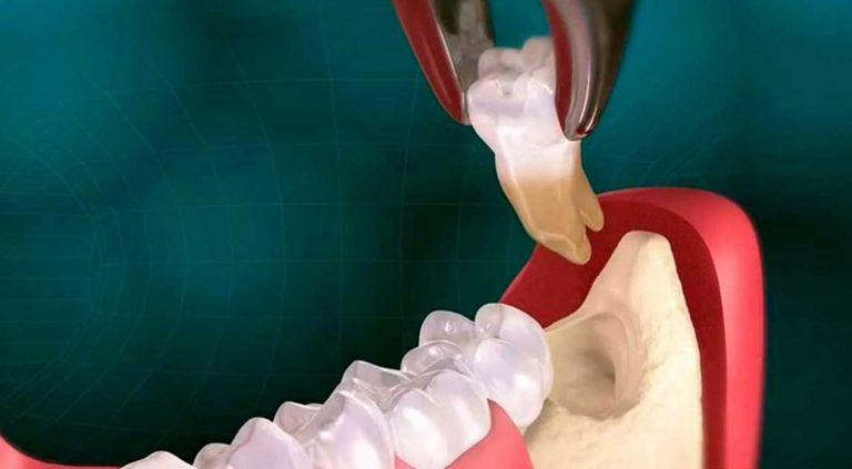 Удаление зуба