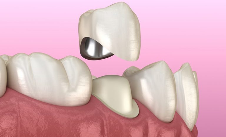 На обточенный зуб надевается металлокерамическая коронка