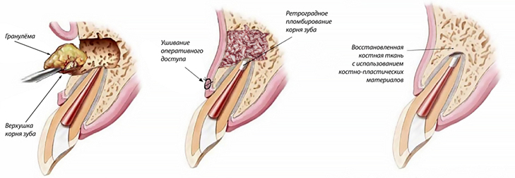 Удаление гранулемы зуба хирургическим методом