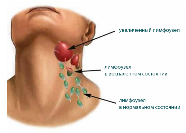Подчелюстной лимфаденит