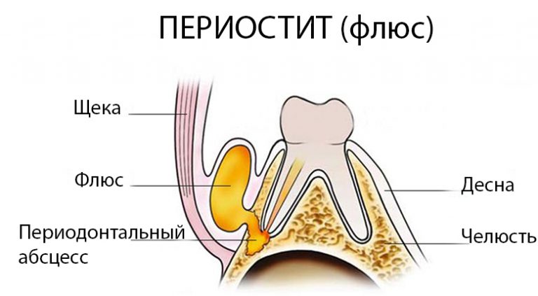 Как выглядит периостит или флюс