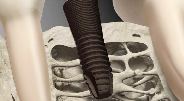 При недостатке костной ткани требуется костная пластика