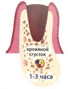 Первая стадия восстановления десны после удаления зуба