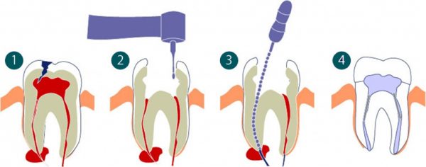 Консервативное лечение кисты челюсти