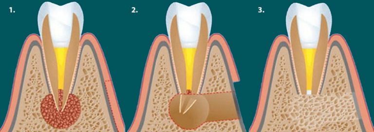 Хирургическое лечение кисты