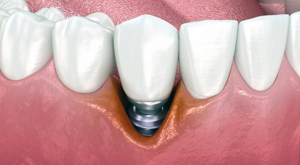 Пример плохой остеоинтеграции импланта