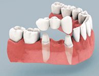 Лечение адентии с помощью несъемного протезирования с опорой на свои зубы
