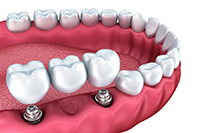 Лечение адентии с помощью несъемного протезирования с опорой на импланты