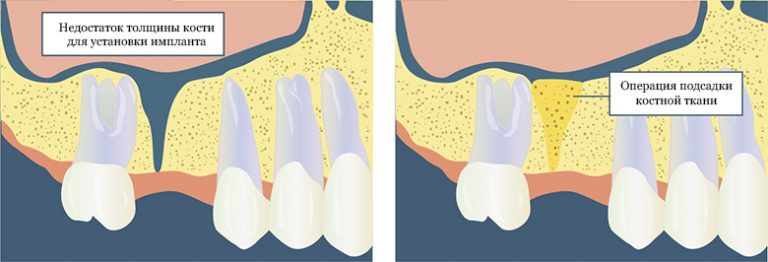 Восстановление объема кости перед имплантацией