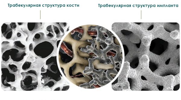 Трабекулярная структура кости и импланта