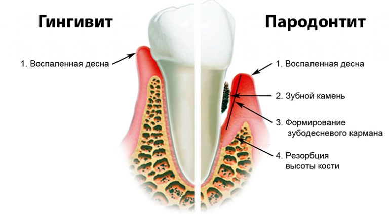 Отличие гингивита от пародонтита