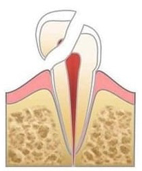 Перелом зуба с обнажением пульпы