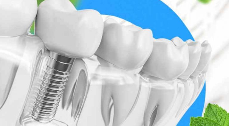 имплант зуба