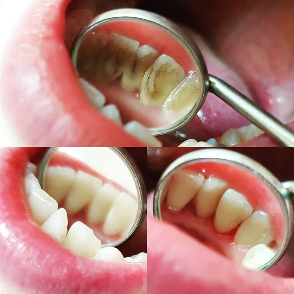 До/после ультразвуковой чистки зубов