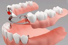 Лечение адентии с помощью частичного съемного протезирования