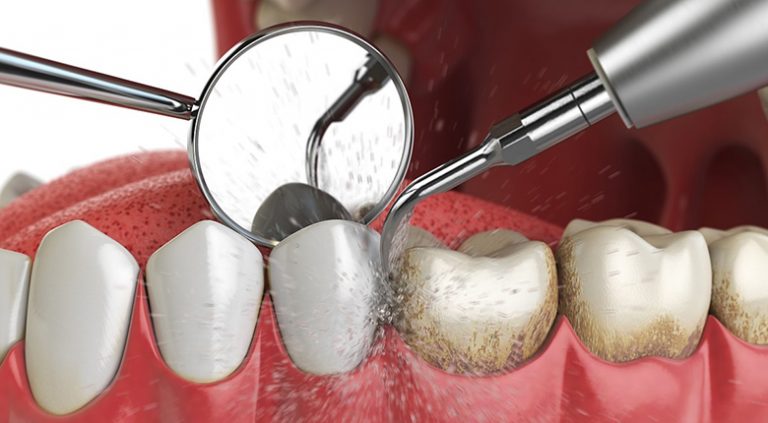 Ультразвуковая чистка зубов