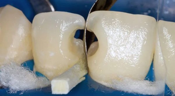 Устранение бокового кариеса происходит по аналогии с лечением обычного кариеса