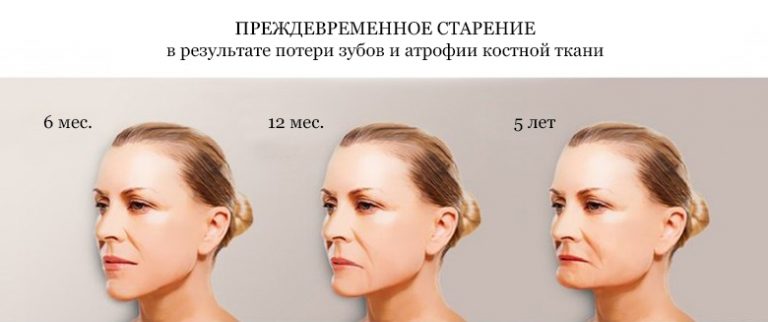 Как атрофия костной ткани сказывается на внешнем виде