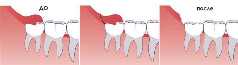 Этапы лечения перикоронита